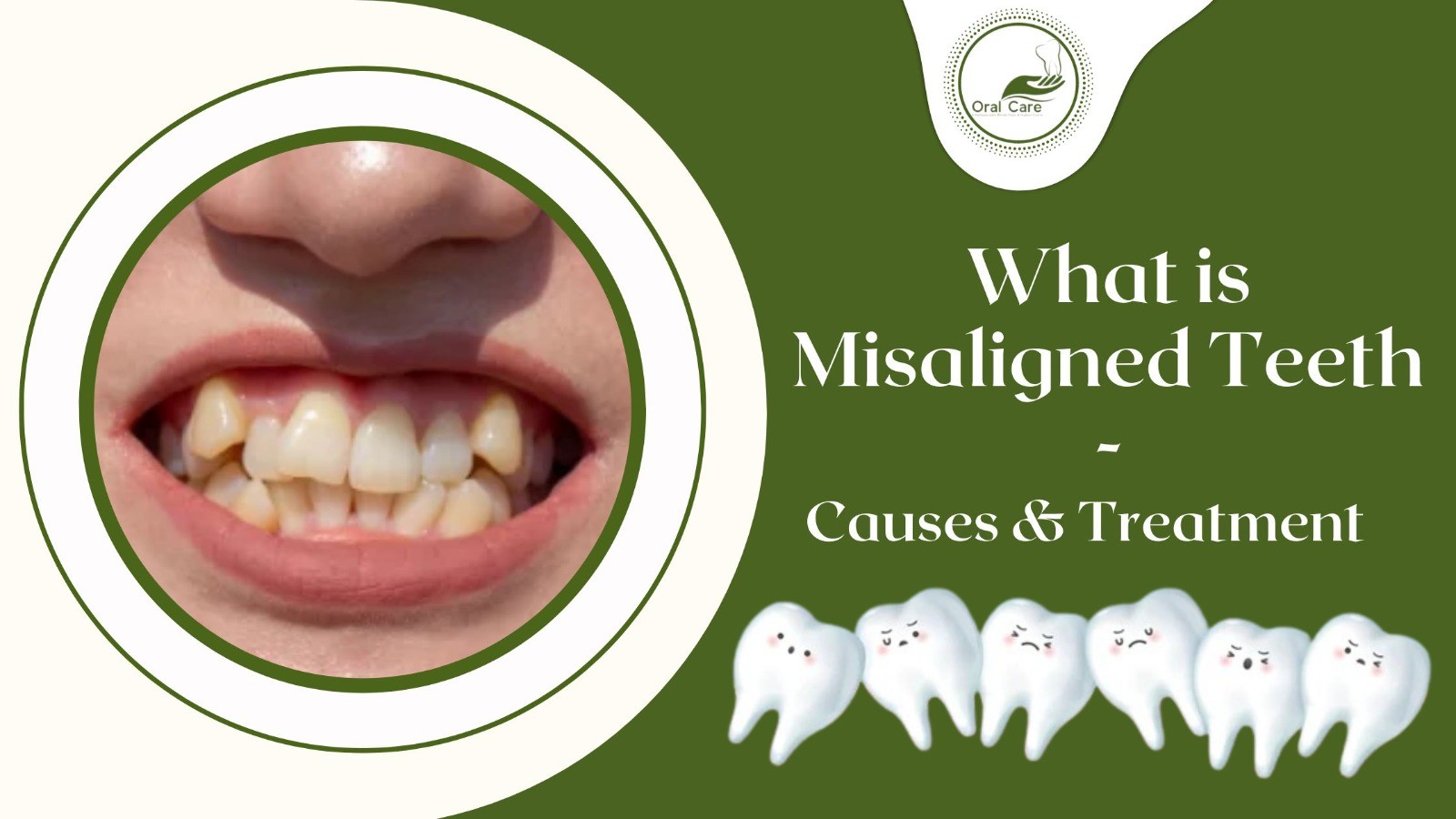 What is Misaligned Teeth-Causes & Treatment @DrGauravSharma